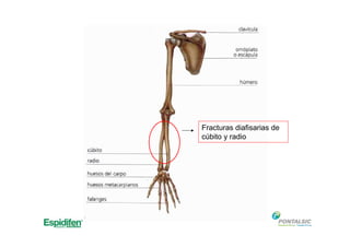 Fracturas diafisarias de
cúbito y radio
 