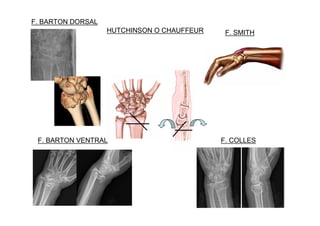F. COLLES
F. SMITH
F. BARTON VENTRAL
HUTCHINSON O CHAUFFEUR
F. BARTON DORSAL
 
