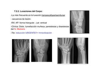 7.2.2. Luxaciones del Carpo:
-La más frecuente es la luxación transescafoperisemilunar
- secuencia de lesión.
-RX: AP: forma triangular , Lat: vertical
-Clínica: Dolor, tumefacción muñeca, parestesias y disestesias
del N. Mediano
-Tto: reducción URGENTE!!+ Inmovilización
 
