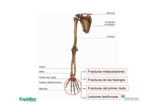 Fracturas metacarpianos
Fracturas de las falanges
Fracturas del primer dedo
Lesiones tendinosas
 