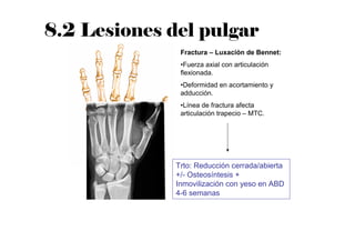 Fractura – Luxación de Bennet:
•Fuerza axial con articulación
flexionada.
•Deformidad en acortamiento y
adducción.
•Línea de fractura afecta
articulación trapecio – MTC.
Trto: Reducción cerrada/abierta
+/- Osteosíntesis +
Inmovilización con yeso en ABD
4-6 semanas
8.2 Lesiones del pulgar
 