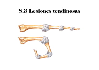 8.3 Lesiones tendinosas
 
