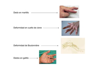 Dedo en martillo
Deformidad en cuello de cisne
Deformidad de Boutonnière
Dedos en gatillo
 