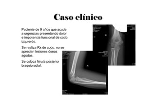 Caso clínico
Paciente de 9 años que acude
a urgencias presentando dolor
e impotencia funcional de codo
izquierdo.
Se realiza Rx de codo: no se
aprecian lesiones óseas
agudas.
Se coloca férula posterior
braquioradial.
 