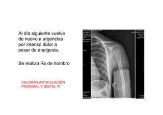 Al día siguiente vuelve
de nuevo a urgencias
por intenso dolor a
pesar de analgesia.
Se realiza Rx de hombro
VALORAR ARTICULACIÓN
PROXIMAL Y DISTAL !!!
 