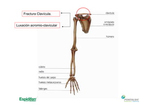 Fractura Clavícula.
Luxación acromio-clavicular
 