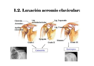 1.2. Luxación acromio clavicular:
Cabestrillo
Quirúrgico.
 