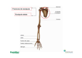 Fracturas de escápula
Escápula alada
 