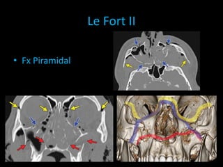Le Fort II
• Fx Piramidal
 
