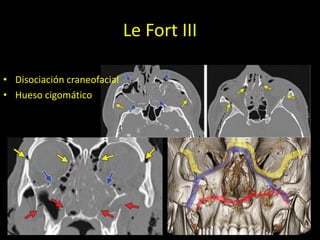 Le Fort III
• Disociación craneofacial
• Hueso cigomático
 