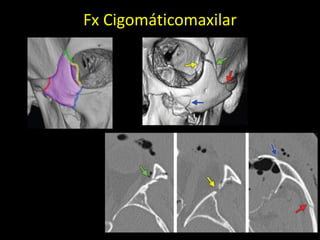Fx Cigomáticomaxilar
 