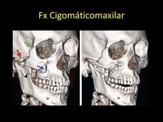 Fx Cigomáticomaxilar
 