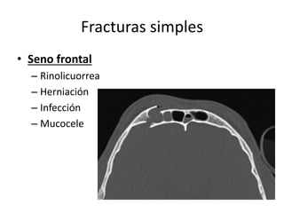 Fracturas simples
• Seno frontal
– Rinolicuorrea
– Herniación
– Infección
– Mucocele
 