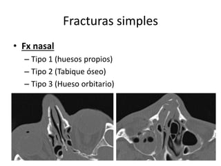 Fracturas simples
• Fx nasal
– Tipo 1 (huesos propios)
– Tipo 2 (Tabique óseo)
– Tipo 3 (Hueso orbitario)
 