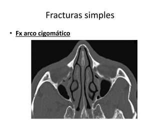 Fracturas simples
• Fx arco cigomático
 