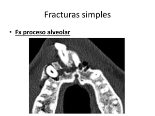 Fracturas simples
• Fx proceso alveolar
 