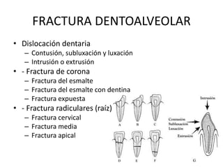 FRACTURA DENTOALVEOLAR
• Dislocación dentaria
– Contusión, subluxación y luxación
– Intrusión o extrusión
• - Fractura de corona
– Fractura del esmalte
– Fractura del esmalte con dentina
– Fractura expuesta
• - Fractura radiculares (raíz)
– Fractura cervical
– Fractura media
– Fractura apical
 