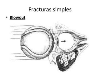 Fracturas simples
• Blowout
 
