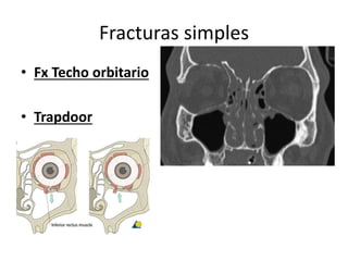 Fracturas simples
• Fx Techo orbitario
• Trapdoor
 