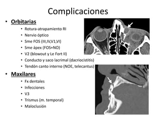 Complicaciones
• Orbitarias
• Rotura-atrapamiento RI
• Nervio óptico
• Sme FOS (III,IV,V1,VI)
• Sme ápex (FOS+NO)
• V2 (blowout y Le Fort II)
• Conducto y saco lacrimal (dacriocistitis)
• Tendón canto interno (NOE, telecantus)
• Maxilares
• Fx dentales
• Infecciones
• V3
• Trismus (m. temporal)
• Maloclusión
 