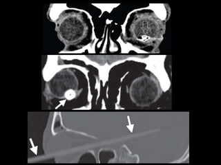 Traumatismos faciales