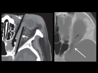 Traumatismos faciales