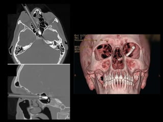 Traumatismos faciales