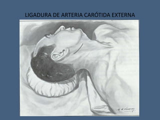 LIGADURA DE ARTERIA CARÓTIDA EXTERNA
 