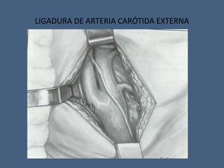 LIGADURA DE ARTERIA CARÓTIDA EXTERNA
 