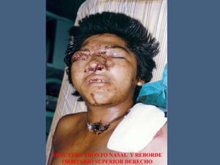 FRACTURA FRONTO NASAL Y REBORDE
ORBITARIO SUPERIOR DERECHO
 