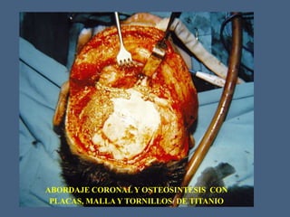 ABORDAJE CORONALY OSTEOSINTESIS CON
PLACAS, MALLA Y TORNILLOS DE TITANIO
 