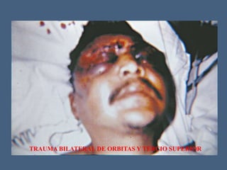TRAUMA BILATERAL DE ORBITAS Y TERCIO SUPERIOR
 