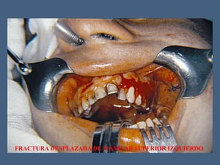 FRACTURA DESPLAZADA DE MAXILAR SUPERIOR IZQUIERDO
 