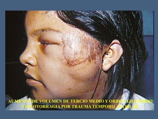 AUMENTO DE VOLUMEN DE TERCIO MEDIO Y ORBITA IZQUIERDO
CON OTORRAGIA POR TRAUMA TEMPORO MAXILAR
 
