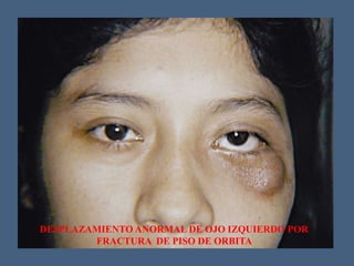 DESPLAZAMIENTO ANORMAL DE OJO IZQUIERDO POR
FRACTURA DE PISO DE ORBITA
 