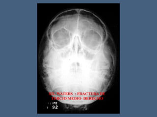RX. WATERS : FRACTURA DE
TERCIO MEDIO DERECHO
 