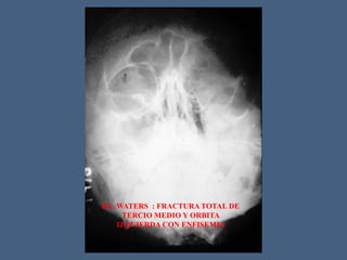 RX. WATERS : FRACTURA TOTAL DE
TERCIO MEDIO Y ORBITA
IZQUIERDA CON ENFISEMIA
 