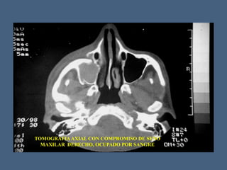 TOMOGRAFIAAXIAL CON COMPROMISO DE SENO
MAXILAR DERECHO, OCUPADO POR SANGRE
 