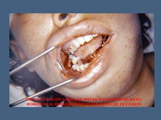 FRACTURA DESPLAZADA DE MITAD POSTERIOR DE RAMA
HORIZONTAL DERECHA CON ALTERACION DE OCLUSION
 