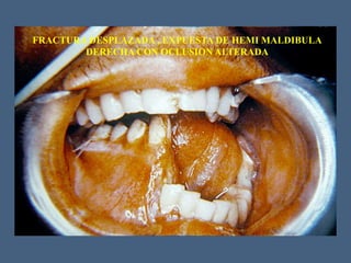 FRACTURA DESPLAZADA , EXPUESTA DE HEMI MALDIBULA
DERECHA CON OCLUSION ALTERADA
 
