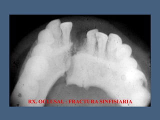 RX. OCLUSAL : FRACTURA SINFISIARIA
 