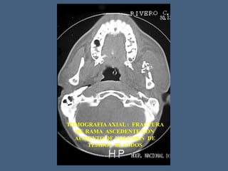 TOMOGRAFIAAXIAL : FRACTURA
DE RAMA ASCEDENTE CON
AUMENTO DE VOLUMEN DE
TEJIDOS BLANDOS
 