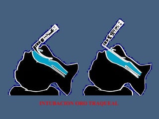 INTUBACION ORO TRAQUEAL
 