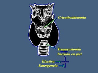 Cricotiroidotomia
Traqueostomia
Incisión en piel
Electiva
Emergencia
 