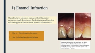 Infraction Tooth Traumatic dental injuries.pptx