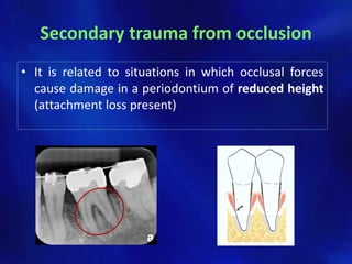 Secondary trauma from occlusion
• It is related to situations in which occlusal forces
  cause damage in a periodontium of reduced height
  (attachment loss present)
 