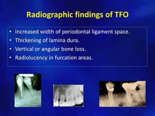 Radiographic findings of TFO
•   Increased width of periodontal ligament space.
•   Thickening of lamina dura.
•   Vertical or angular bone loss.
•   Radiolucency in furcation areas.
 
