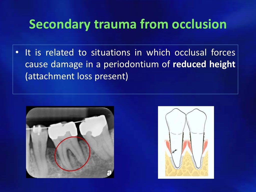 Trauma from occlusion
