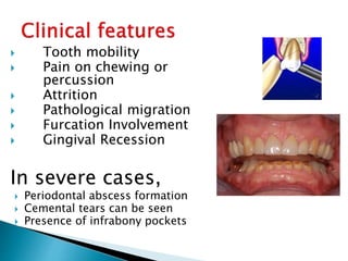  Tooth mobility
 Pain on chewing or
percussion
 Attrition
 Pathological migration
 Furcation Involvement
 Gingival Recession
In severe cases,
 Periodontal abscess formation
 Cemental tears can be seen
 Presence of infrabony pockets
 