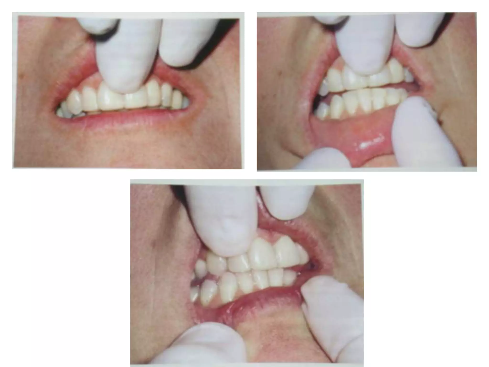Trauma from occlusion